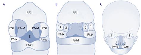 Frontonasal Dysplasia