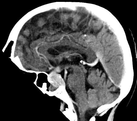 Pituitary Metastasis Image Radiopaedia Org