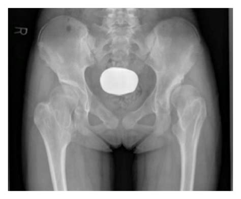 A Anteroposterior Pelvic Radiograph At Initial Presentation B