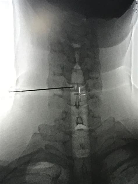 Tratamiento para hernia discal sin cirugía con láser