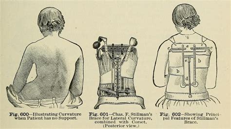 A History Of Scoliosis Non Surgical Diagnosis Treatment Scoliosis Sos