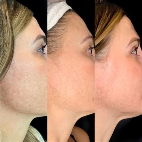 Chemical Peels In Salt Lake City And Provo Ut