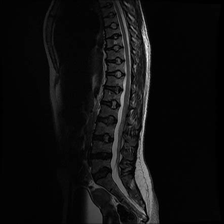 H Shaped Vertebra Image Radiopaedia Org