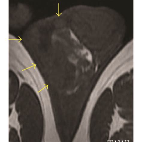 Imaging Of The Fibrous Pseudotumor In The Scrotum Scrotal Ultrasound