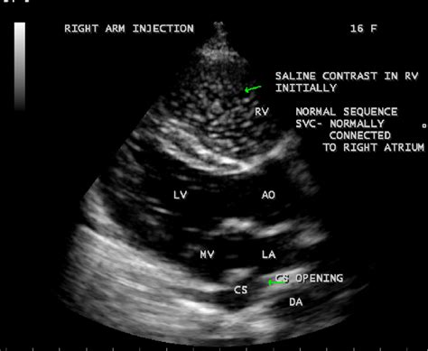 Bubble Study Showing The Normal Connection Of Right Superior Vena Cava