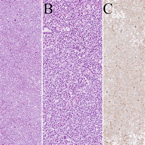 A Hande Section Of The Tumor 100 × Magnification B 200 ×