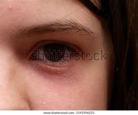 Eyelid Atopic Dermatitis Eczema Scaling Red Foto Stock 1541906255 Shutterstock