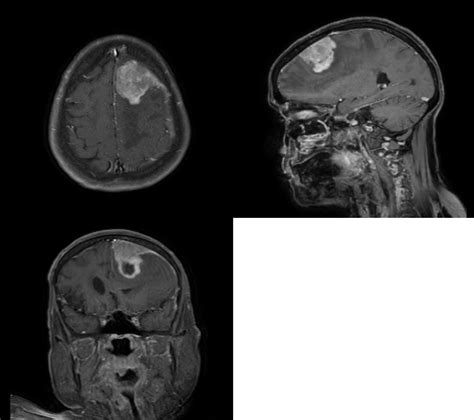 Dura Based Rhabdoid Glioblastoma Masquerading As Meningioma A Rare