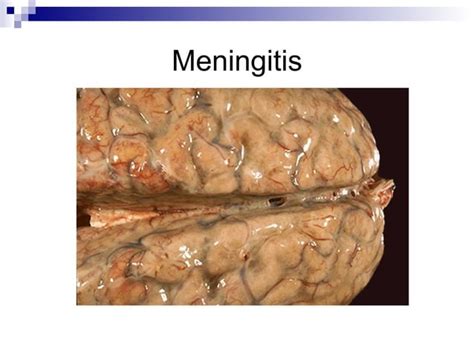 39 Infecciones Del Sistema Nervioso Central PPT