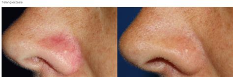 Laser Treatment of Blood Vessels – Yardley Dermatology Associates