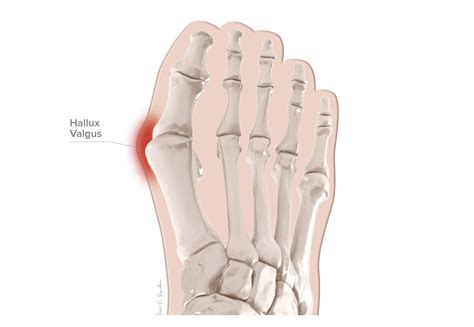 Hallux Valgus or Bunions – KevinRoot Medical