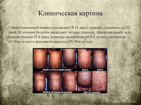 Натуральная оспа