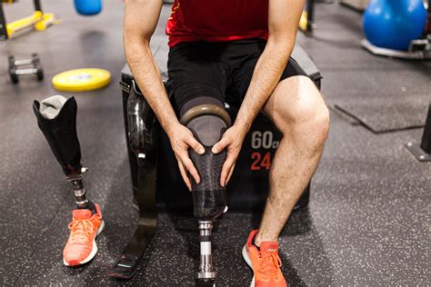 Above-the-Knee Leg Amputations: Here's What to Expect