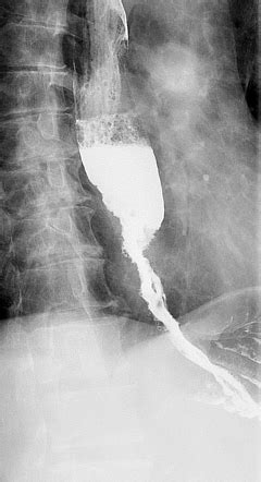 Esophageal Adenocarcinoma Radiology Case Radiopaedia Org