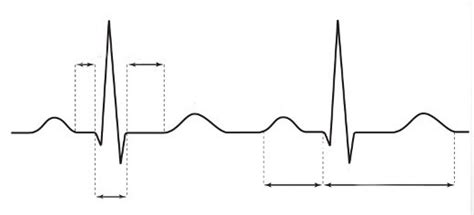 How To Read A Ecg Diagram Quizlet