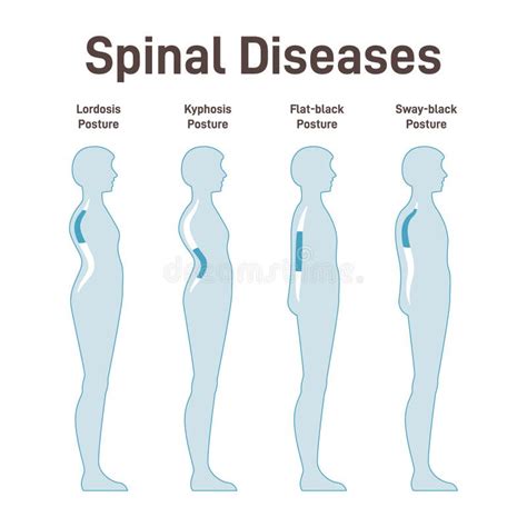 Diseases Of The Spine Scoliosis Lordosis Kyphosis Body Posture Defect