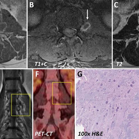 Case 1 Preoperative Axial T1 Weighted T1 MRI Without A And With