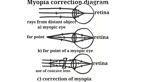 Myopia Correction Diagram How To Draw Myopia Correction Diagram