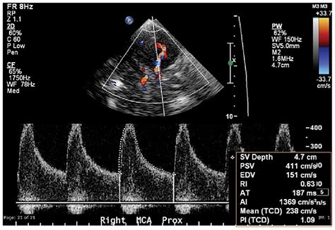 Frontiers Transcranial Doppler Ultrasonography As A Diagnostic Tool