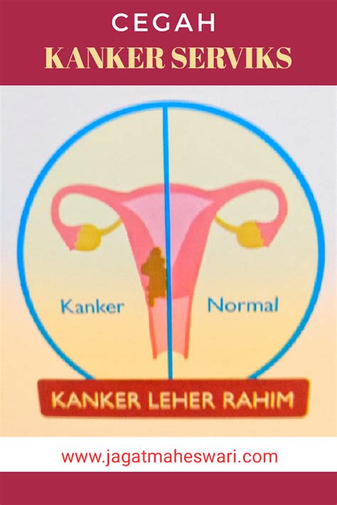 Kanker Leher Rahim Newstempo