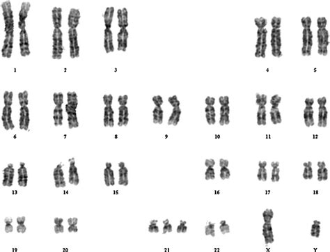 Marfan Syndrome Karyotype