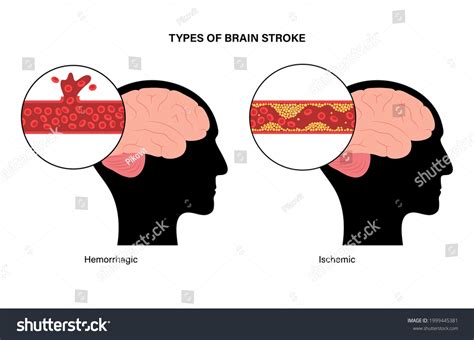 Brain Stroke Hemorrhagic Ischemic Problem Arteriosclerosis Stock Vector