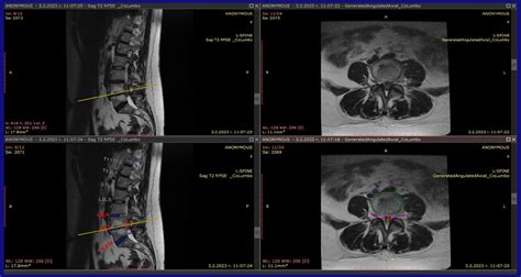 Lumbar Spine Mri Interpretation