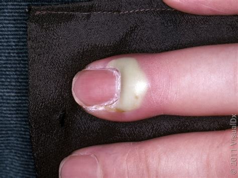 What Does A Nail Bed Infection Look Like Find Out With Pictures Goodrx