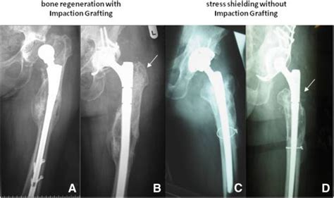 Radiographic Assessment Preoperative And Two Years Postoperative Download Scientific Diagram