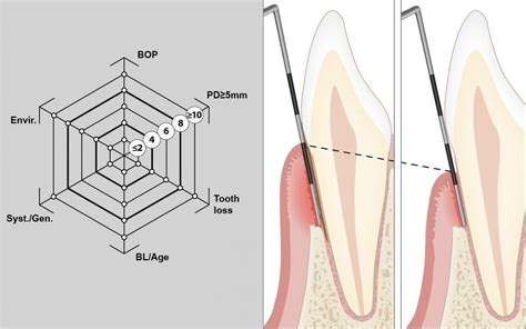 Perio Tools Your Online Portal For Periodontal Tools