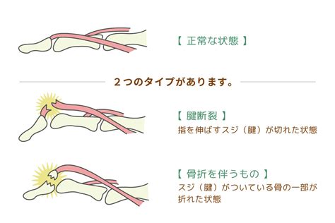 指の捻挫、突き指 岐阜市 森整形外科リハビリクリニック