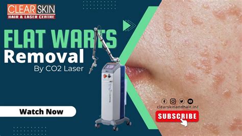 Amazing Ways To Get Rid Of Skin Warts Permanently || Co2 Laser Treatment for Flat Warts removal ...