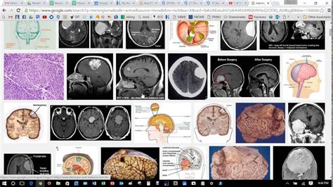 Adult Primary Brain Tumors Youtube