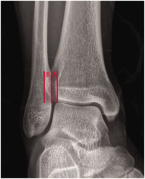 Distal Tibiofibular Joint X Ray