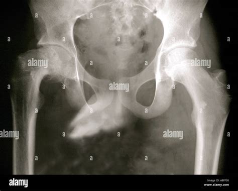 X ray slipped upper femoral epiphysis Stock Photo - Alamy