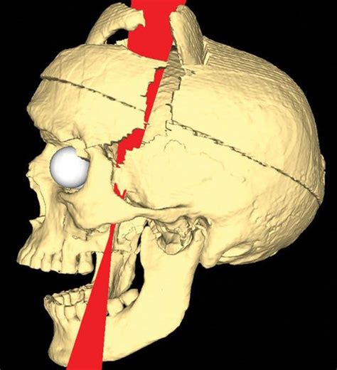 The Frontal Lobe of Phineas Gage - Past Medical History