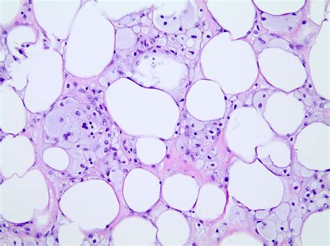 Fat Necrosis Histology