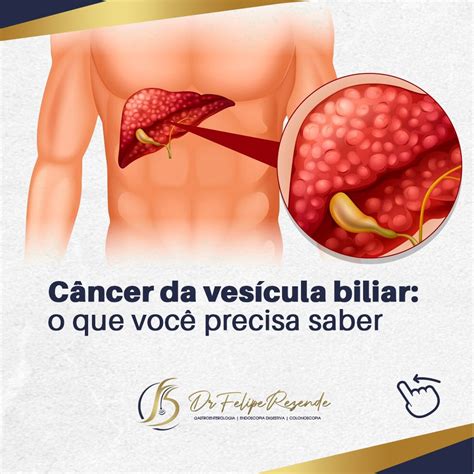 Dr Felipe Rezende Blog Câncer na vesícula biliar o que você