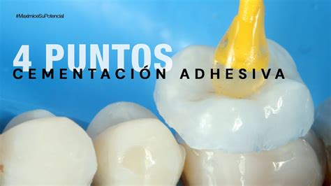 Puntos Importantes En La Cementaci N Adhesiva Maximicesupotencial