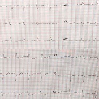 Electrocardiogram Showing Sinus Rhythm With Right Bundle Branch Block