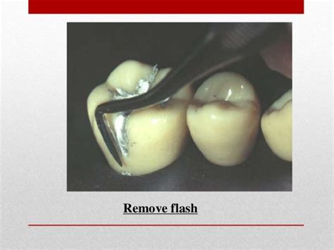 procedure for amalgam restoration