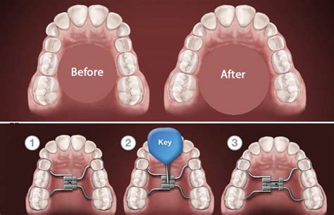 Treatment Of Maxillary Stenosis Dr Jamilian