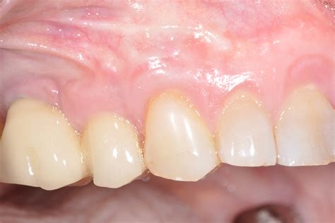 Récession gingivale - 26 Victor Hugo