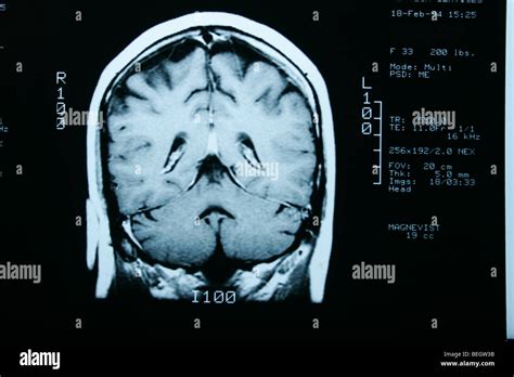 Corpus callosum mri hi-res stock photography and images - Alamy