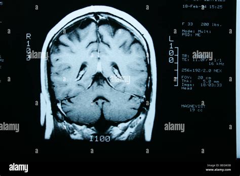 MRI Imagen de resonancia magnética del cerebro del paciente con y sin