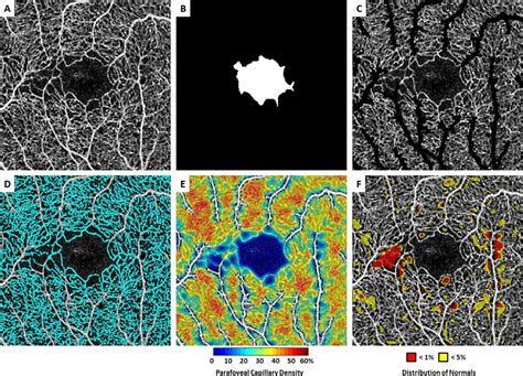 Foveal Avascular Zone Morphology And Parafoveal Capillary Perfusion In Sickle Cell Retinopathy