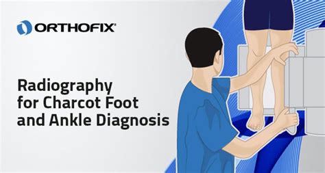 Radiography For Charcot Foot And Ankle Diagnosis Orthofix