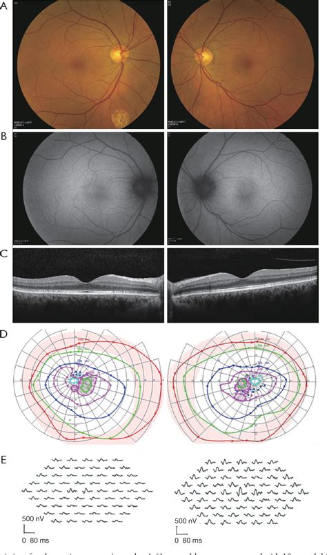 Figure 1 From Diagnosis And Treatment Of Autoimmune Retinopathy