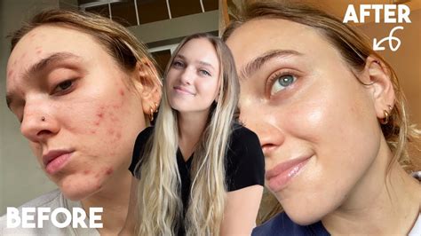 How I Healed My Adult Cystic Hormonal Acne Naturally My Skincare