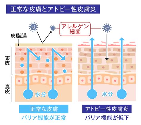 アトピー性皮膚炎の入浴や保湿のポイント｜原因・症状と主な治療内容 メディプラス乾燥予防研究所